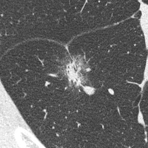 （b）高精細CTの肺